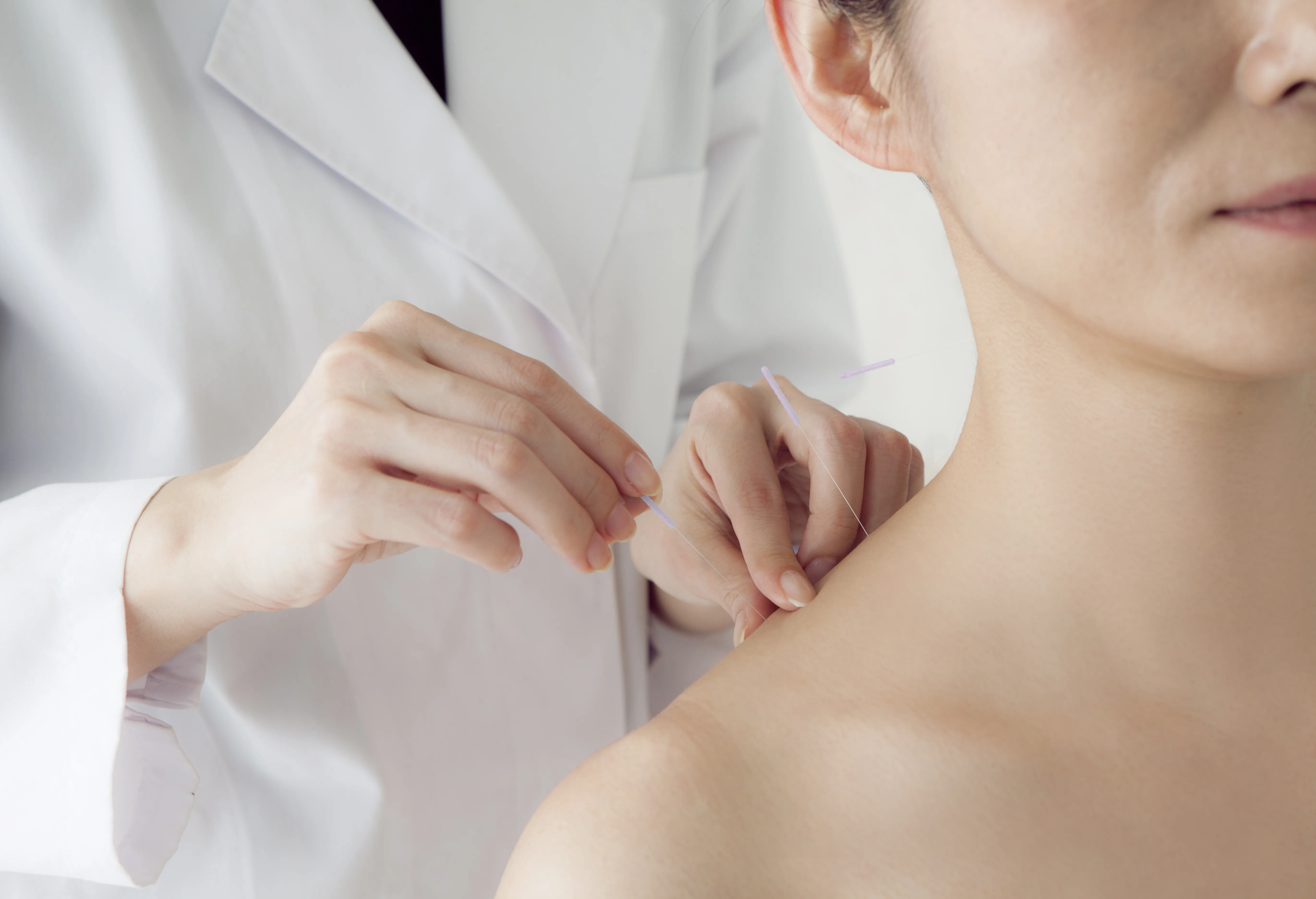 Practitioner in white coat placing acupuncture needles at a patient's neck and shoulder