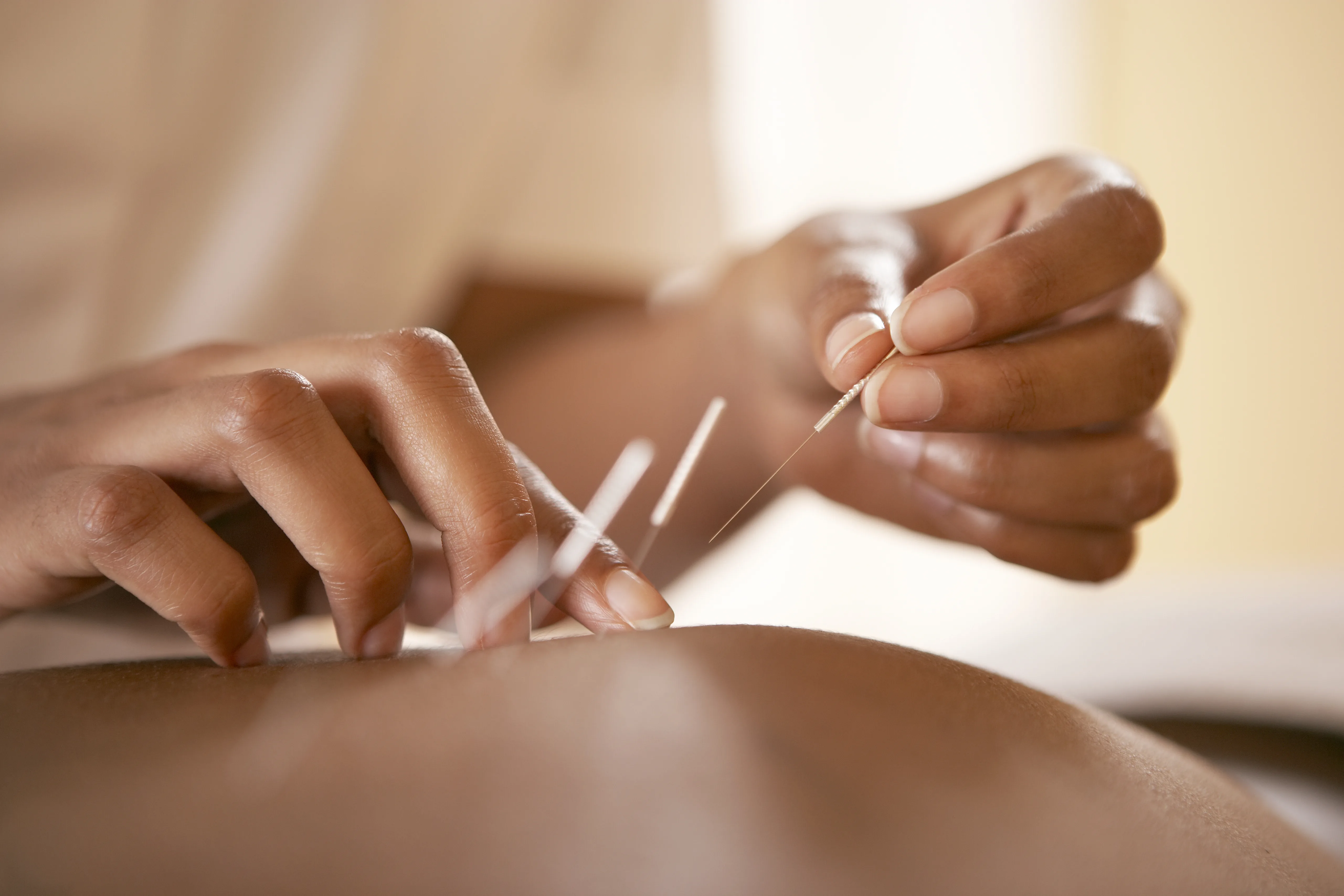 Fine acupuncture needles placed along a bare back in soft warm light